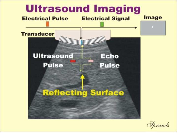 Figure 8: Ultrasound image grayscale shading is determined by the intensity of the wave that has bounced off from the reflected surface [23].