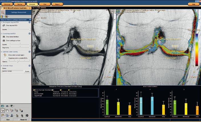 38 Application tips Using IntelliSpace Portal for assessment of cartilage Contributed by Harry Peusens, Marius van Meel, Siryl van Poppel, MR Application, Best, The Netherlands.