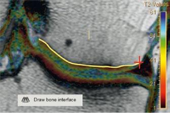 Draw the ROI by placing the first point on the bonecartilage interface on one side of the lesion and the second point on the other side of the lesion.