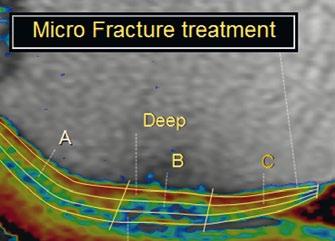 A curved layered ROI is used to analyze a complete cartilage structure. The curved ROI can be adapted to the actual shape of cartilage.