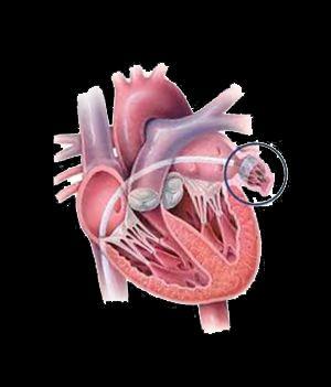 Left Atrial Appendage Closure Device Application: Prevent stroke of nonvalvular Atrial Fibrillation (AF) patients with thrombi originating in the LAA Potential Market Size: AF is the most common