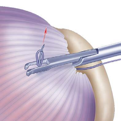 Dual Row Spanning Suture Passage 1. The lateral portal is preferred as the viewing portal because it permits a 50-yard line view of the cuff tear.