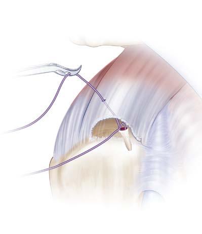 Sutures are passed approximately 20 mm medial to the free edge of the tendon in a retrograde fashion using a penetrating suture grasper such as the Cleverhook Instrument.