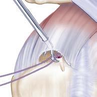 Alternatively, a posterior or posterolateral portal may be used as the viewing portal and sutures may be passed in an antegrade fashion using the EXPRESSEW III Flexible Suture Passer.