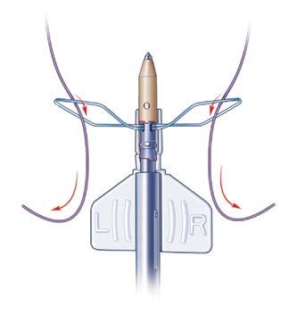 At this point, 1 suture from the anterior anchor and 1 suture from the posterior anchor are retrieved through the lateral portal. These do not need to be retrieved through a cannula.