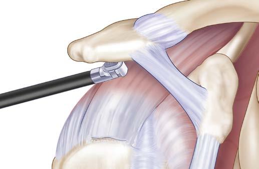 Single Row Repair Initial Arthroscopy and Cuff Assessment 1. The patient is placed in either the lateral decubitus or beach chair position.