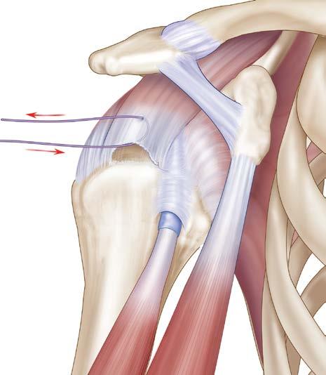 Single Row Repair Single Row 1. Use a suture-passing device, and pass a strand of ORTHOCORD High Strength Orthopedic Suture or *ETHIBOND Suture through the edge of the torn rotator cuff.