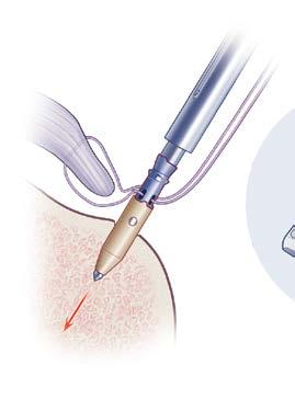 Single Row Repair Placement of Implant 1. The first pair of sutures are retrieved out of the clear cannula in the lateral insertion portal. 2.