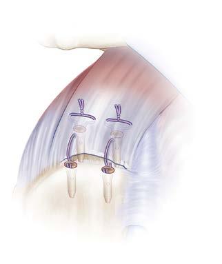 Double Row Repair Medial and Lateral Cuff Fixation Technique 1. The medial row of sutures is placed utilizing an anchor first technique.