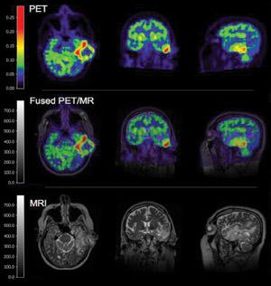 the 4DMPET Project goal Why PET/MRI?