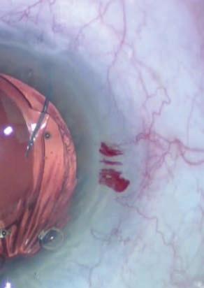 anterior chamber Remove lens from anterior