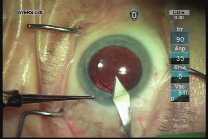 Uneventful cataract surgery, but post-op