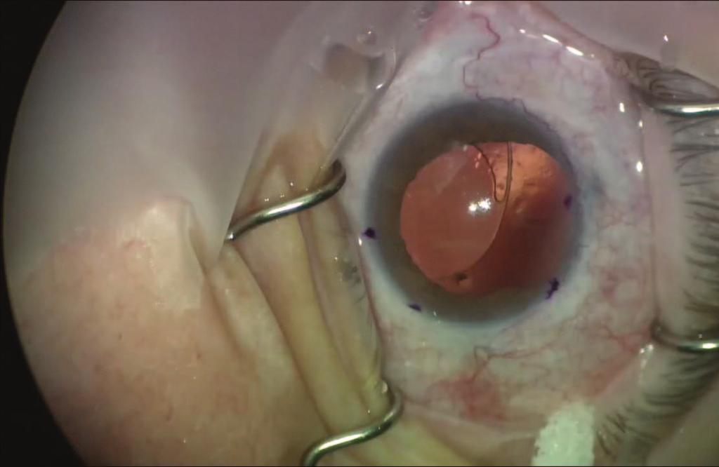 decentered multifocal IOL Atonic pupil Replace