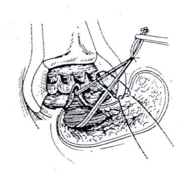 Đặt một dây thun vào đường rò sau khi đã cắt được đường rò nhưng không xác định được khối cơ vòng ngoài liên quan với đường rò, việc cột dây thun này còn