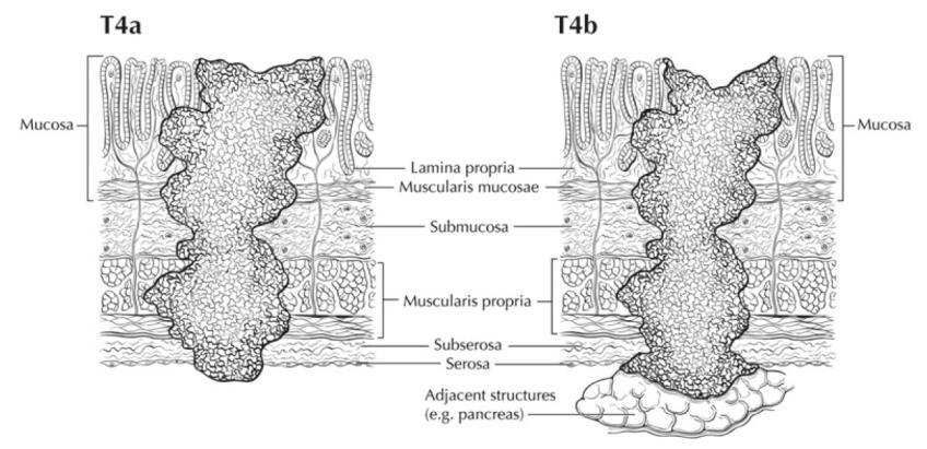 Hình 3: Xâm lấn của u theo chiều sâu từ T1-4 SM được chia thành: - SM1 hoặc T1b1 (bưới xâm lấn 0,5mm vào cơ niêm) - SM2 hoặc T1b2 (bướu xâm lấn