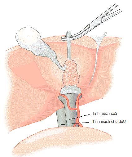 Hình 3: Cắt ngang OMC, bóc tách ngược lên trên (Nguồn: ACS Surgery Principle and