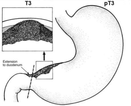 Hình 5: Hình ăn lan theo chiều sâu vào trong lòng ống tiêu hóa 2.