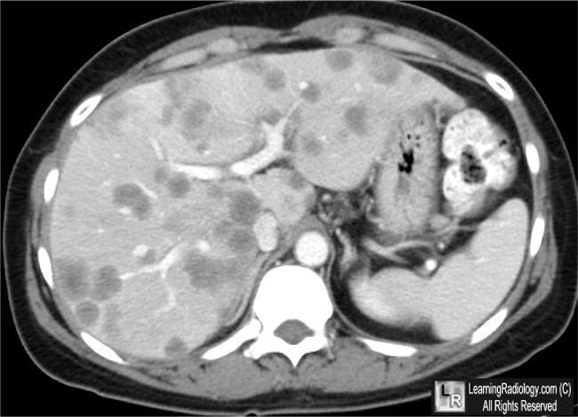 - Trong trường hợp không rõ ràng chẩn đoán sang thương gan dù đã làm các XN hình ảnh học: Siêu âm sinh thiết u và/hay MRI bụng với Gadolinum và/hay PTNS thám sát.