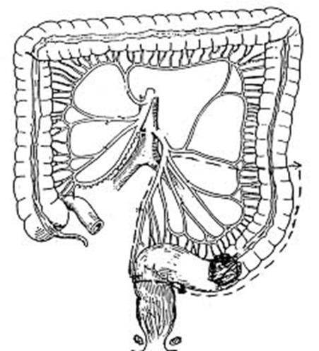 - Hậu môn nhân tạo trên dòng - Cắt đại tràng qua nội soi ổ bụng Năm 1990, kỹ thuật cắt đại tràng qua nội soi ổ bụng được áp dụng ở một số nước. Tuy nhiên kỹ thuật này chưa phổ biến và còn hạn chế.