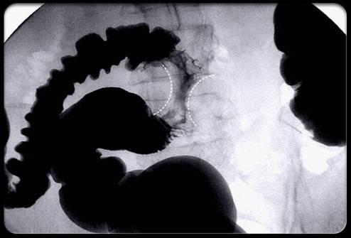 Hình 2. Hình ảnh lõi táo (ung thư đại tràng) trên phim Xquang đại tràng 2. Nội soi đại trực tràng sinh thiết Nếu xét nghiệm cho thấy khả năng có khối u, bước kế tiếp là thực hiện sinh thiết.