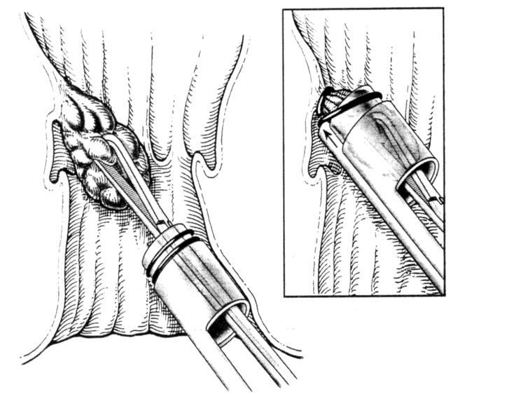 Hình 2. Kỹ thuật thắt trĩ bằng dây thun (Nguồn Surgical Treatment of Hemorrhoids) Các vị trí thực hiện thủ thuật Hình 3.
