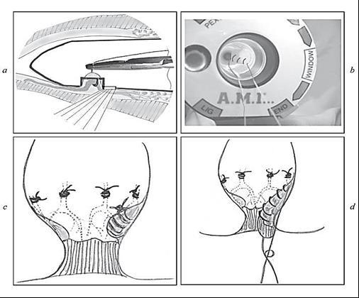 Kỹ thuật thắt mạch trĩ với siêu âm Doppler hướng dẫn Kỹ thuật này với dụng cụ có tên là Moricon gồm một đầu do siêu âm Doppler gắn liền trong một ống soi hậu môn.