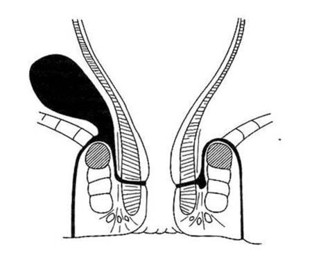 Rò giữa cơ thắt: chiếm tỷ lệ 45% trong nhóm bệnh của BV St Mark, thường là rò đơn giản, nhưng đôi khi cho các đường rò cao hơn đổ vào trực tràng hay không có lỗ rò ngoài.