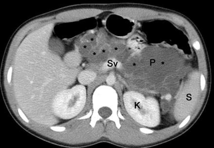CT of the ABDOMEN -Good Image Quality important to make proper diagnosis The Abdomen view above is pictured in Cross-Sectional