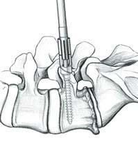 S 4 Spinal System 3.2 3.2 Polyaxial Screw Application To place a polyaxial screw, first fully engage the 3.5mm hexagonal tip of the polyaxial screwdriver FW173R into the head of the screw (Fig.