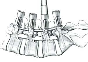 S 4 Spinal System 7.2 7.2 Rotation Maneuvers The de-rotation sleeves FW183R should be used during rotation maneuvers to prevent splaying of the implant head.