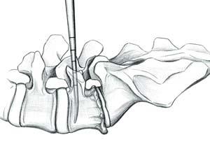 1. Pedicle Preparation 1. After determination of the pedicle entry point use the bone awl FW190R to open the pedicle canal (Fig. 1). Bone awl FW190R Fig.