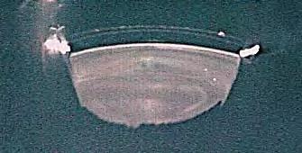 Phakic Implants Artisan Lens Staar