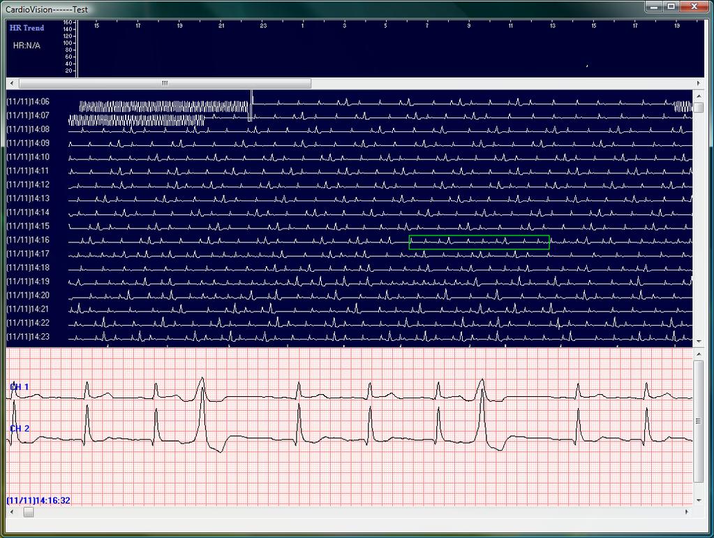 6.4 Advanced-Auto-Analyzed Full Disclosure: 1. The above is the PageScan display. It is the instantaneous Full Disclosure display of all of the patient s ECG data.