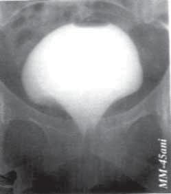 pentru prolapsul de gr. I şi cistocel voluminos complicat cu IUE s-a practicat istmopexie cu sau fără interpoziţie vezico-vaginală a uterului, varianta I (Fig. 5) (103 cazuri) FIGURA 4.