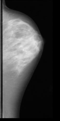 (a) Original 100-micron/pixel mammogram and (b) its non-overlapping 512x512 sub-images (b) Once FARs have been generated for each sub-image, they are encased in