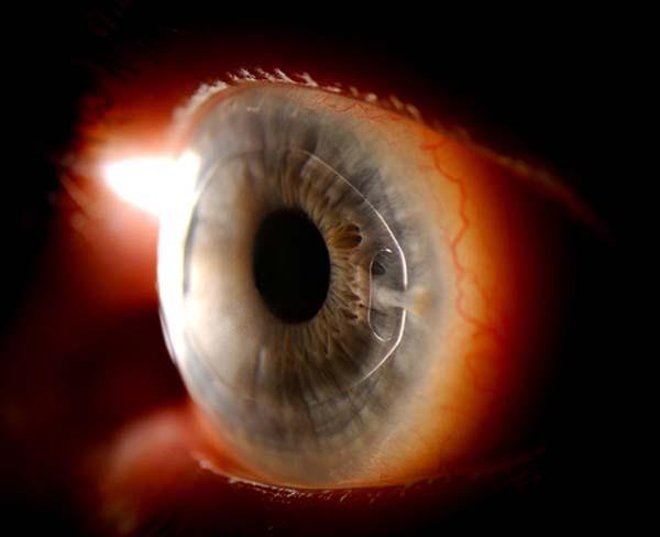 opacities Contact with crystalline lens causes cataracts.