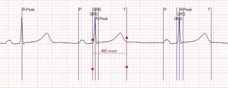 Slide 3 6: Example: Annotated ECG signal in HL7 Standard