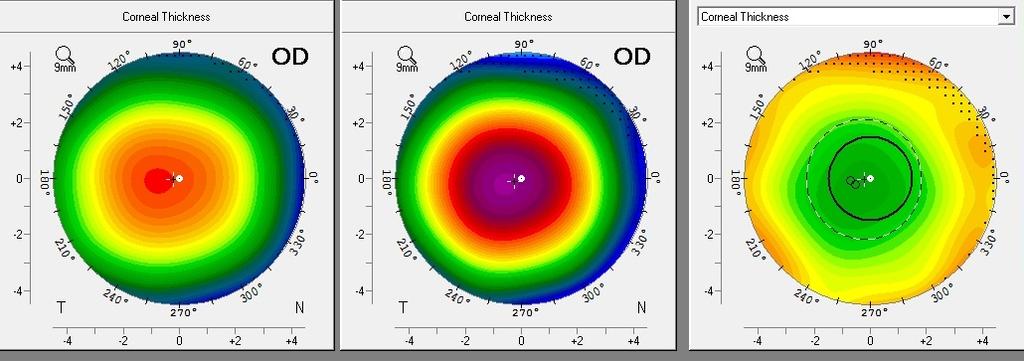 Methods Centration Analysis by pachymetry differential maps: Distance of the thickest point from apex (vertex*) and pupil centre ReLEx Smile (OD) Mean Spherical Equivalent of the Correction -4.
