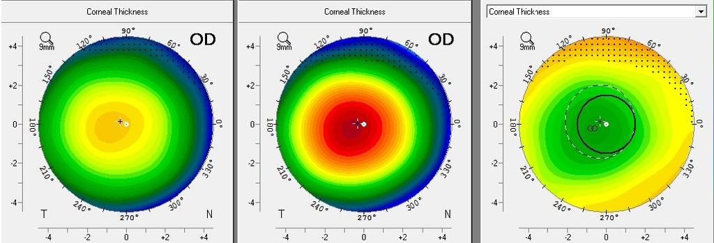 421 Thickest point Fs-LASIK (OS) Mean Spherical Equivalent of the Correction - 5.