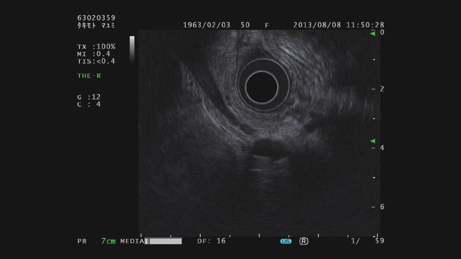 This mode increases the penetration of the ultrasound waves, allowing for better visualization of