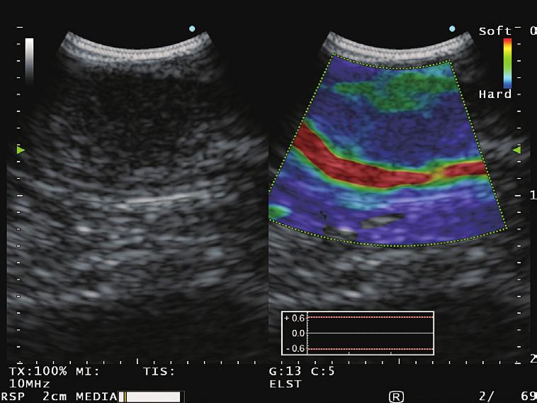 When the function is active, the physician is able to hear the sound wave and view it on the monitor alongside the EUS image to identify the area of interest.