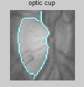 The proposed method in [4] uses manual threshold analysis, color component analysis and ROI (Region of Interest) based segmentation for the detection of the cup.