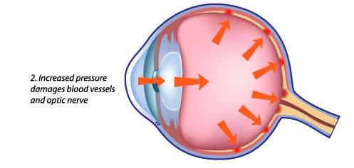 Retina Increased pressure can damage the