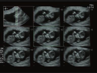 function, which allows the users to review the fetus