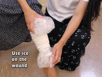 If available, put some ice on the wound, both above and below the charcoal plaster. If it becomes too painful remove the ice.