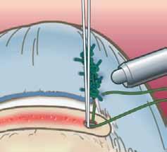 If a crescent suture hook is used again, it may be inserted through the posterior cannula.