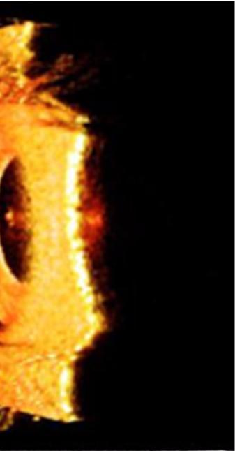 4-D OCT imaging of the anterior eye focusing on