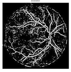 Fig5: optic disc removed image After optic disc removal the image is adjusted to increase its contrast. After adjusting operation the blood vessel will be brighter than the previous image.