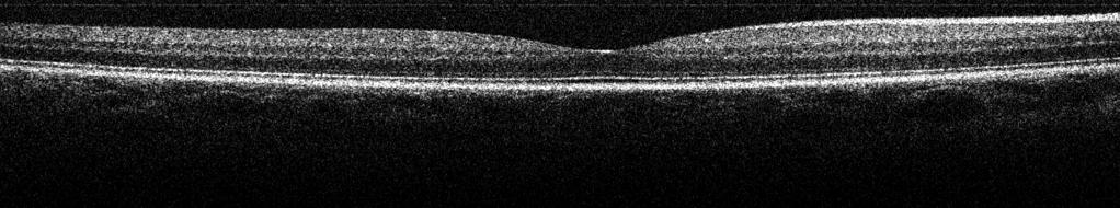 Layers of the retina visible in FF-SS-OCT.