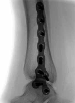 0 mm screws can be placed in the slots of the plate above the level of the ankle joint to provide fixation.